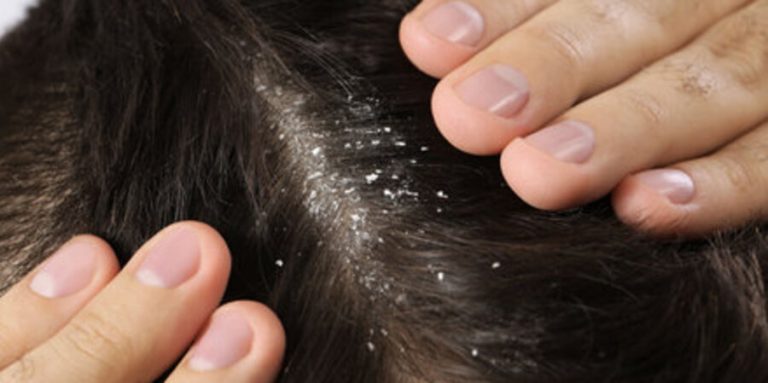 Ketombe Membandel dan Menempel di Kulit Kepala? Coba 7 Cara Ini