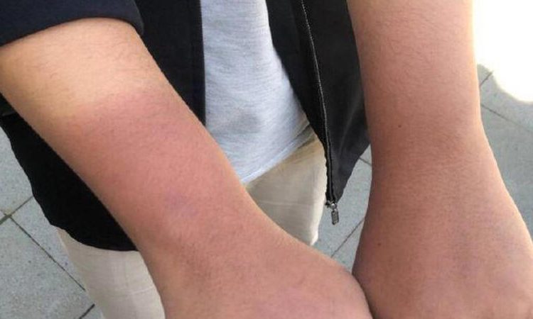 Cara Menghilangkan Belang di Tangan dengan Cepat dan Mudah