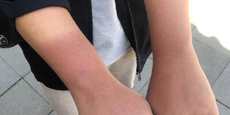 Cara Menghilangkan Belang di Tangan dengan Cepat dan Mudah