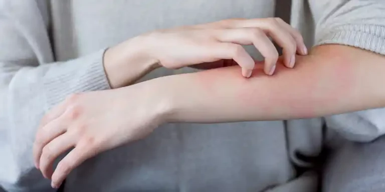 Kenapa Ada Bercak Merah pada Kulit Paha? Ini 7 Penyebab yang Perlu Diketahui