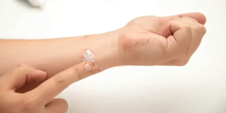 10 Macam Penyakit Kulit yang Sering Terjadi dan Penyebabnya