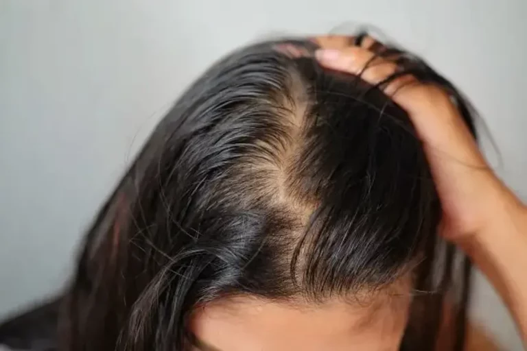 Apa Itu Alopecia Areata? Kenali Penyebab dan Cara Mengatasinya