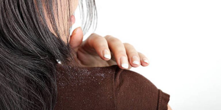 10 Cara Ampuh Menghilangkan Ketombe Berkerak di Kepala