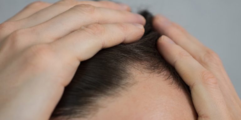 Hati-Hati! 7 Kebiasaan Sehari-hari yang Bisa Memicu Kebotakan Dini