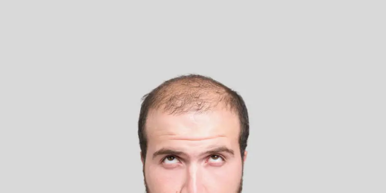 Faktor Genetik dan Gaya Hidup: Penyebab Rambut Rontok Parah pada Pria Muda