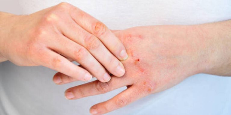 Penyebab Bintil Merah di Kulit dan Cara Mengatasinya