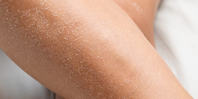 Kulit Kering Rentan Alami Dermatographia, Kenali Gejala dan Penanganannya