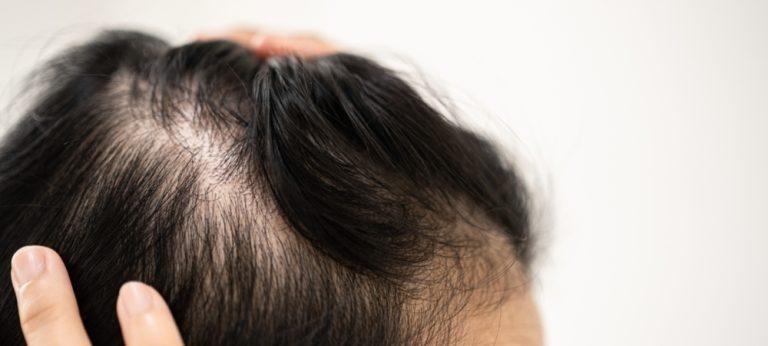 Cara Mengatasi Rambut Pitak: Panduan Lengkap Menumbuhkan Rambut Kembali