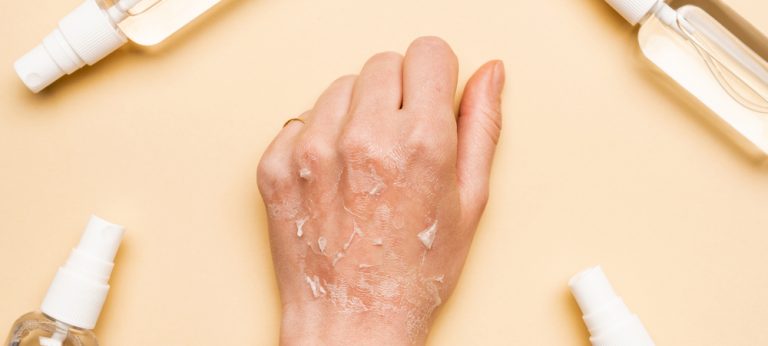 Kulit Mengelupas di Tangan: Penyebab, Cara Mengatasi, dan Pencegahannya