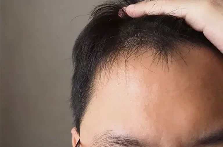 Penyebab Rambut Rontok pada Pria dan Cara Mengatasinya