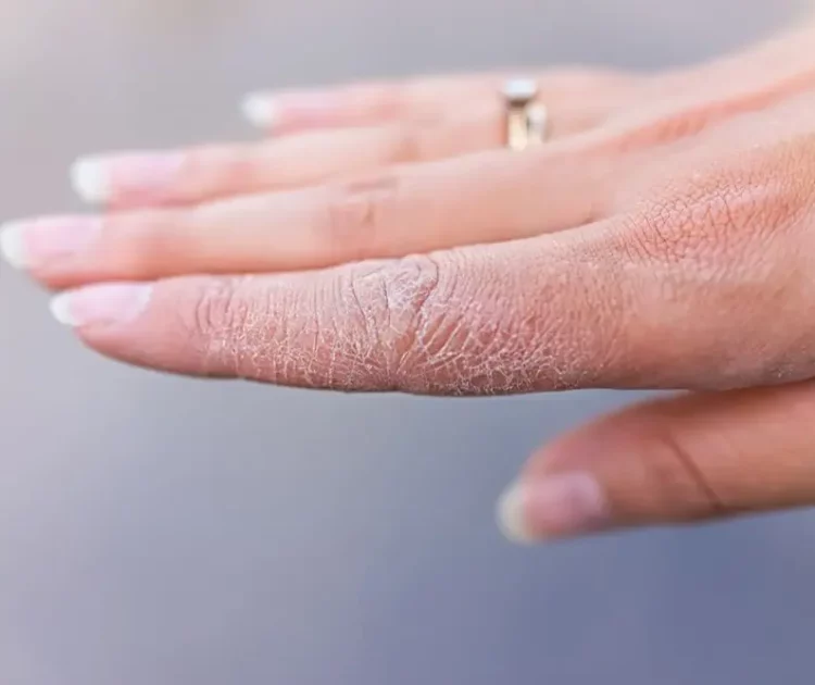 Kulit Tangan Pecah-Pecah: Penyebab dan Cara Mengatasinya