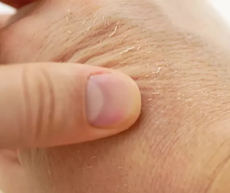 Kenapa Kulit Tangan Kering? Ini Penyebab dan Solusinya!