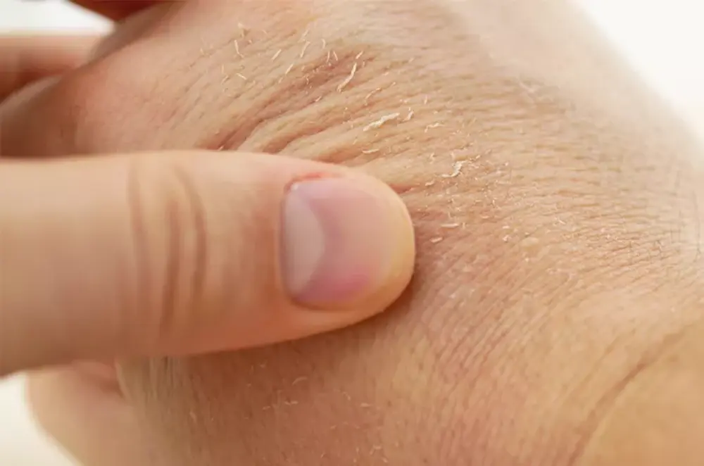 Kenapa Kulit Tangan Kering? Ini Penyebab dan Solusinya!