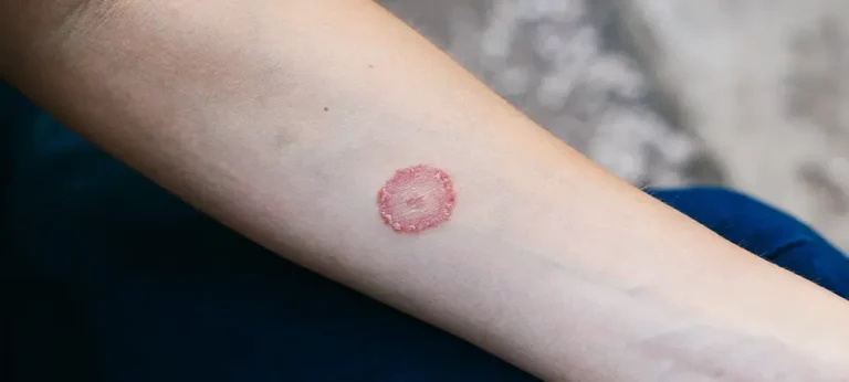 Cara Menghilangkan Dark Spot di Tangan Secara Efektif