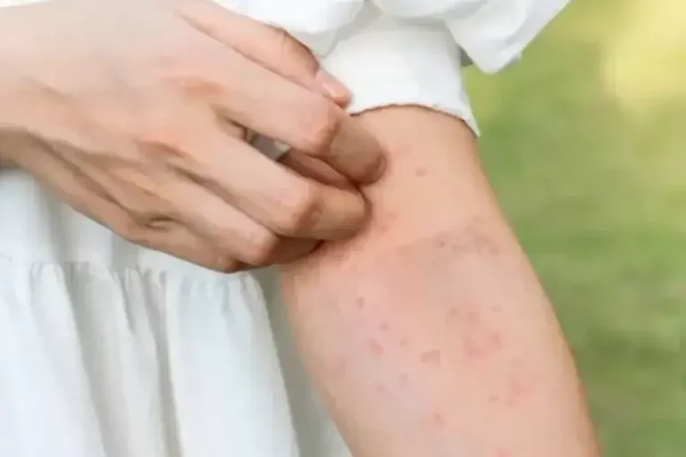 Gatal karena Keringat: Kenapa Bisa Terjadi dan Cara Mengatasinya