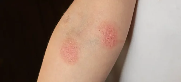 Bintik Merah di Kaki dan Kulit yang Tidak Gatal: Apa Penyebabnya dan Cara Mengatasinya?