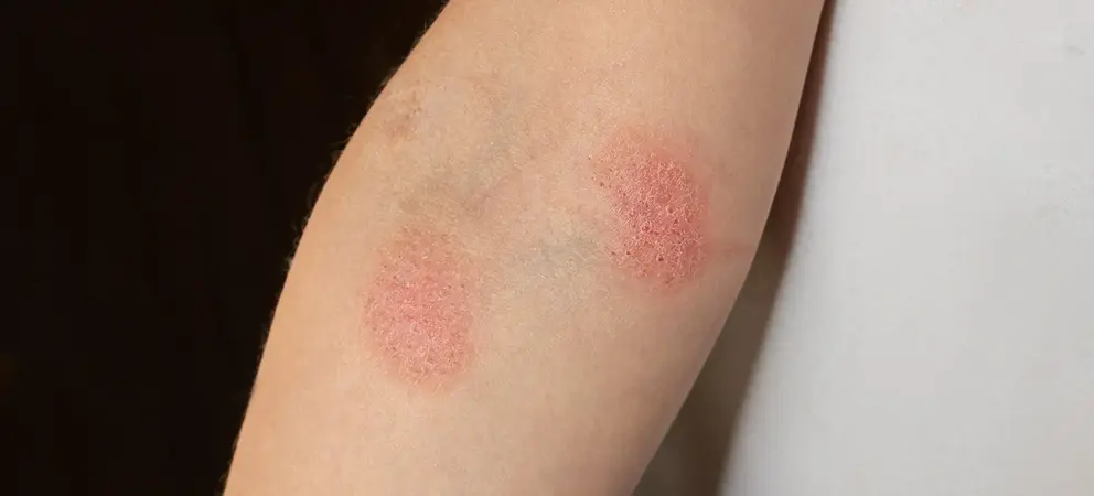 bintik merah pada kulit tidak gatal