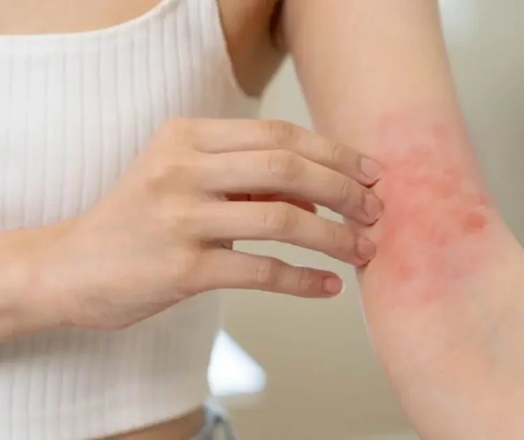 Apakah Eksim Menular? Cek Faktanya Disini!