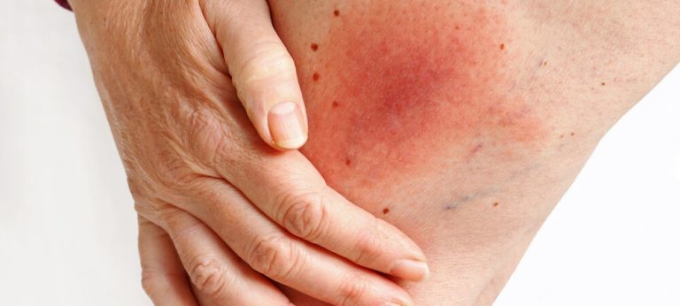 Gatal pada Kulit? Bisa Jadi Pruritus, Bukan Hanya Panu