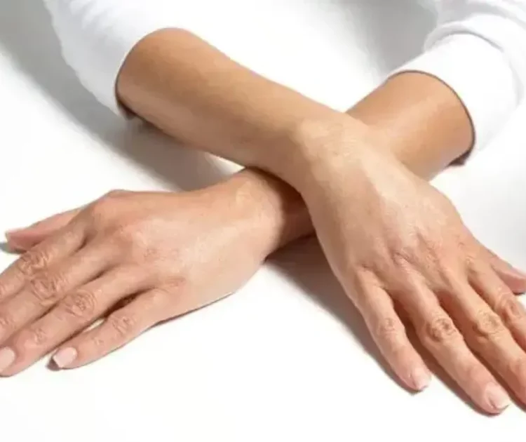 Cara Ampuh Mengatasi Kulit Belang dengan Body Lotion yang Tepat