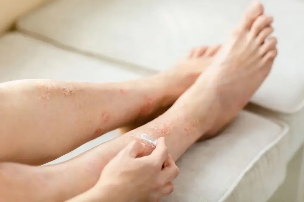 bagaimana cara mengetahui apakah eksim sudah mulai sembuh? Simak ciri-ciri eksim yang mau sembuh dan cara merawatnya supaya kulit bisa kembali sehat.