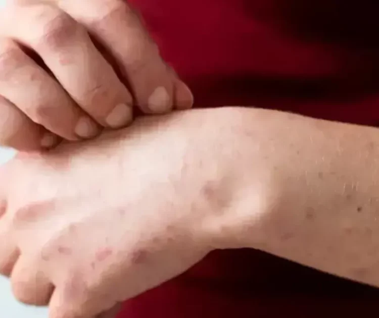 Bruntusan di Tangan: Penyebab, Cara Mengatasi, dan Perawatan yang Tepat