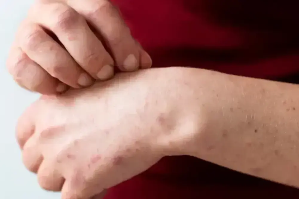 Bruntusan di Tangan: Penyebab, Cara Mengatasi, dan Perawatan yang Tepat