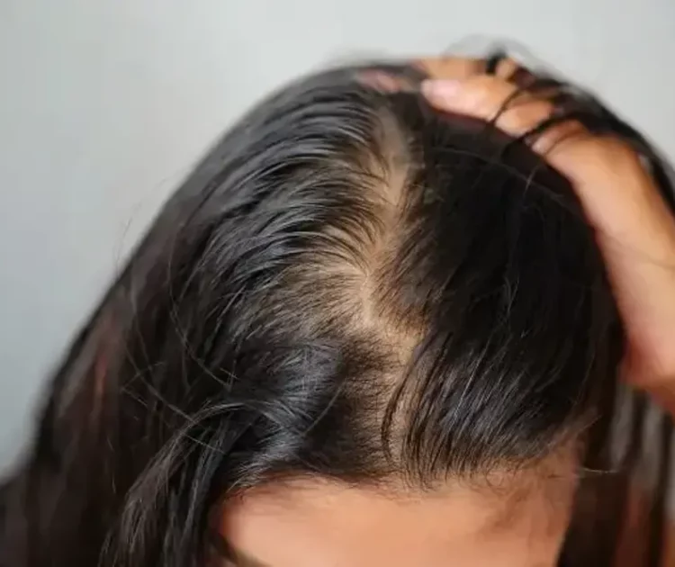 Rambut Tiba-tiba Pitak: Penyebab dan Cara Mengatasinya