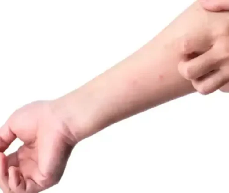 Bentol Bentol Kecil di Kulit: Penyebab, Cara Mengatasi, dan Tips Perawatan