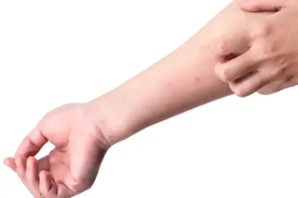 Bentol Bentol Kecil di Kulit: Penyebab, Cara Mengatasi, dan Tips Perawatan