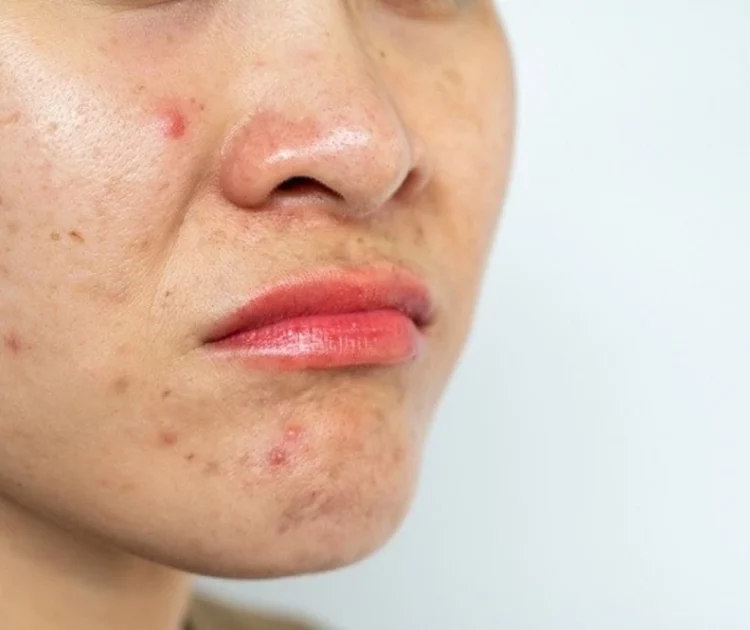 Kulit Bruntusan Penyebab dan Cara Mengatasinya