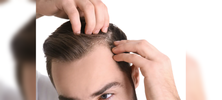 Rambut Kering Bikin Minder? Ini 7 Cara Ampuh Mengatasinya untuk Pria!