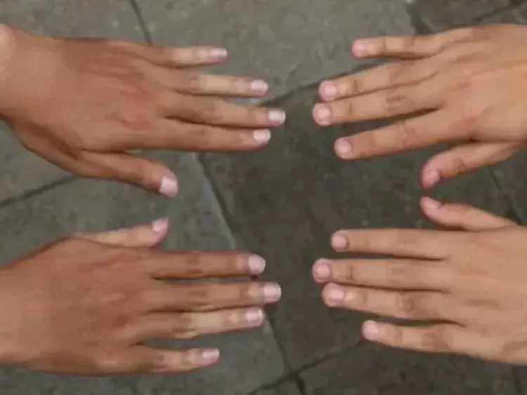 Kulit Belang: Penyebab, Cara Mengatasi, dan Perawatan yang Efektif