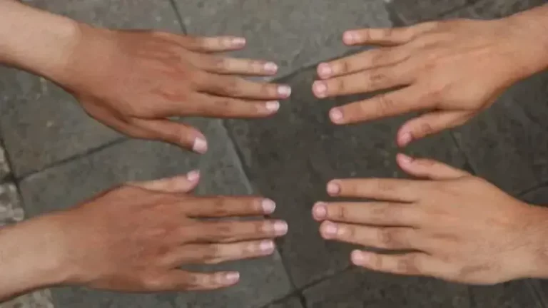 Kulit Belang: Penyebab, Cara Mengatasi, dan Perawatan