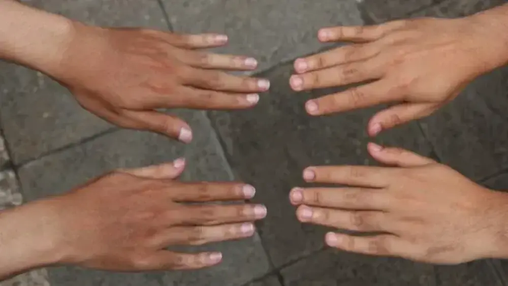 Kulit Belang: Penyebab, Cara Mengatasi, dan Perawatan yang Efektif