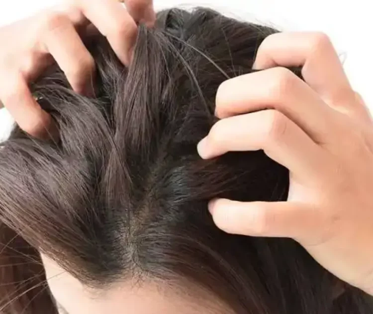 Kulit Kepala Gatal, Penyebab dan Cara Mengatasinya