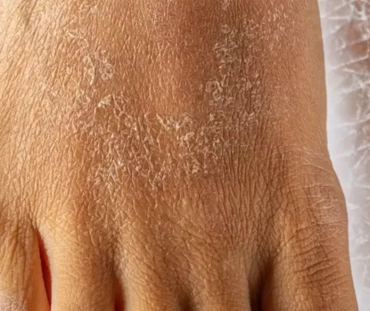 Kulit Bersisik Bukan Sekadar Kering Biasa, Ini yang Perlu Diketahui