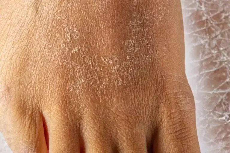 Kulit Bersisik Bukan Sekadar Kering Biasa, Ini yang Perlu Diketahui