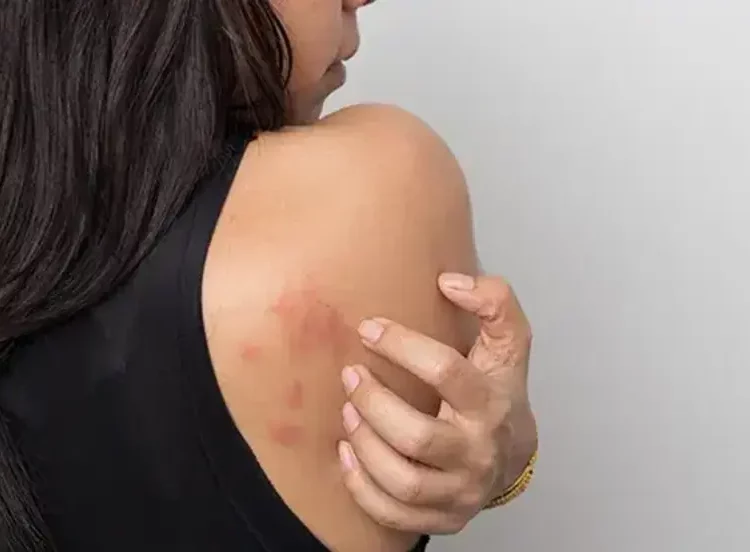 Cara Menghilangkan Biang Keringat