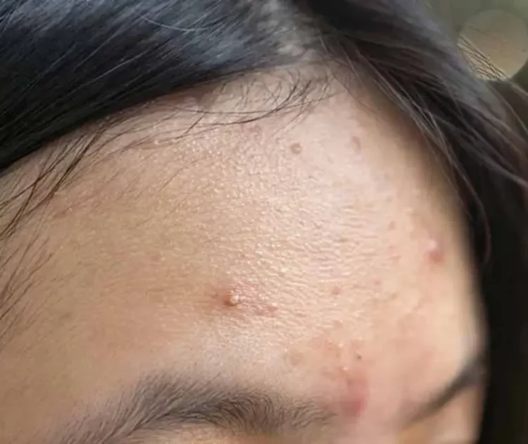 Akibat Bruntusan: Penyebab, Cara Mengatasi, dan Solusi untuk Kulit Lebih Halus