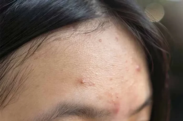 Akibat Bruntusan: Penyebab dan Cara Mengatasinya