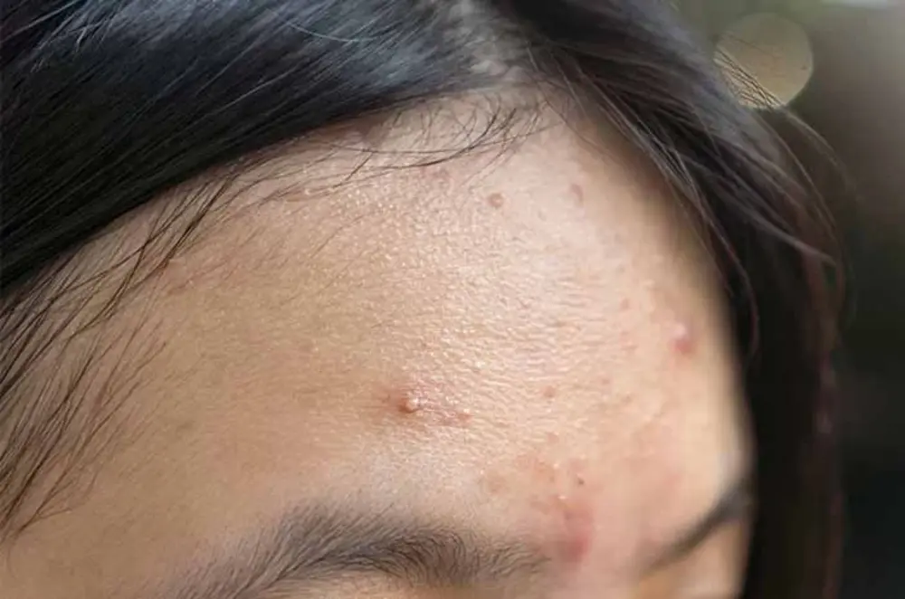 Akibat Bruntusan: Penyebab, Cara Mengatasi, dan Solusi untuk Kulit Lebih Halus