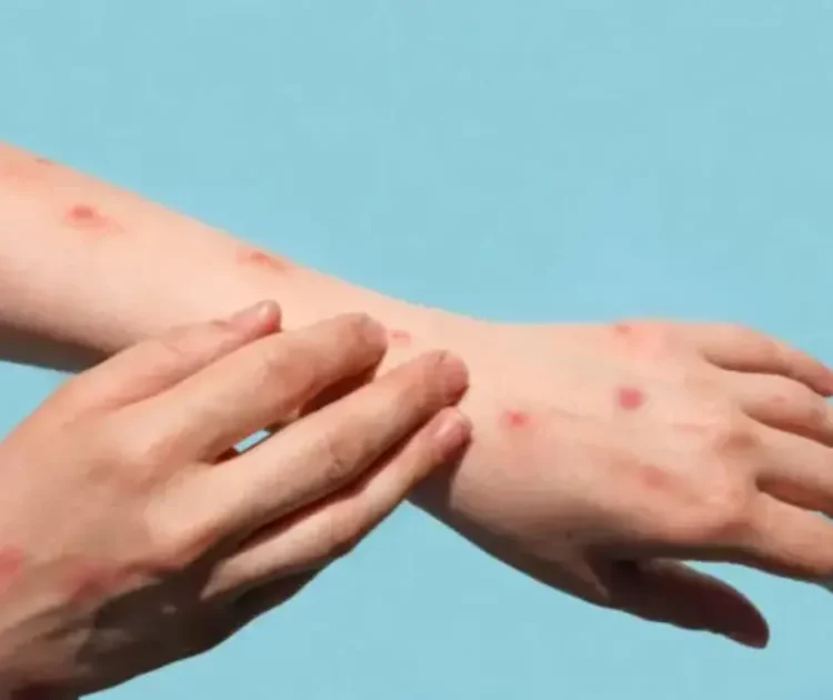 Kenapa Tangan Bintik Merah? Kenali Penyebab dan Cara Menanganinya