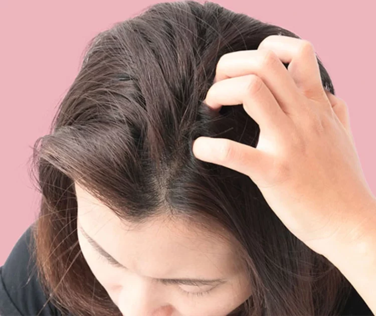 Rambut Gatal: Penyebab dan Cara Mengatasinya dengan Mudah