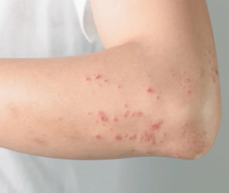 Berapa Lama Biduran Sembuh? Yuk, Cari Tahu Tanpa Panik!