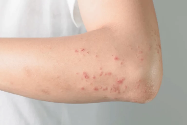 Berapa Lama Biduran Sembuh? Yuk, Cari Tahu Tanpa Panik!