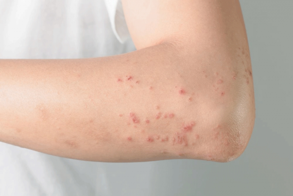 Berapa Lama Biduran Sembuh? Yuk, Cari Tahu Tanpa Panik!