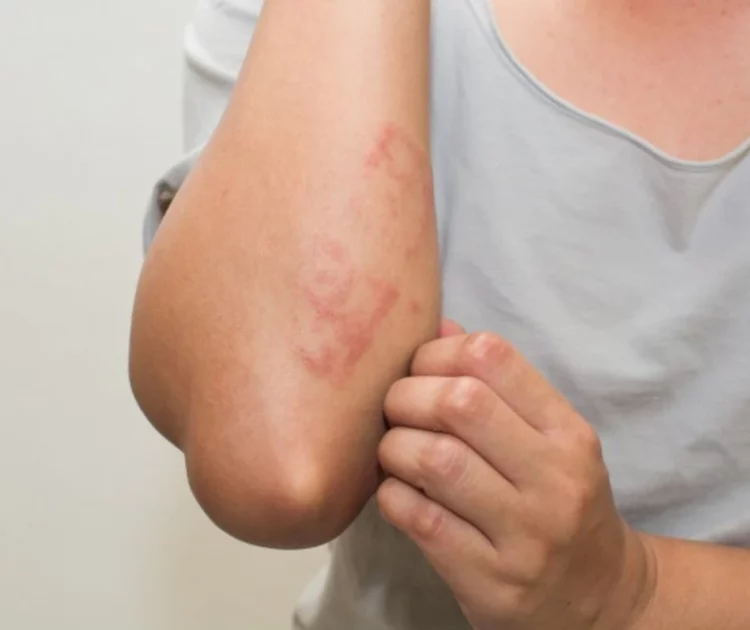 Bercak Merah pada Kulit: Penyebab dan Cara Mengatasinya