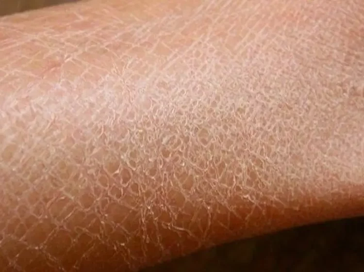 Cara Mengatasi Kulit Kering Bersisik dan Gatal