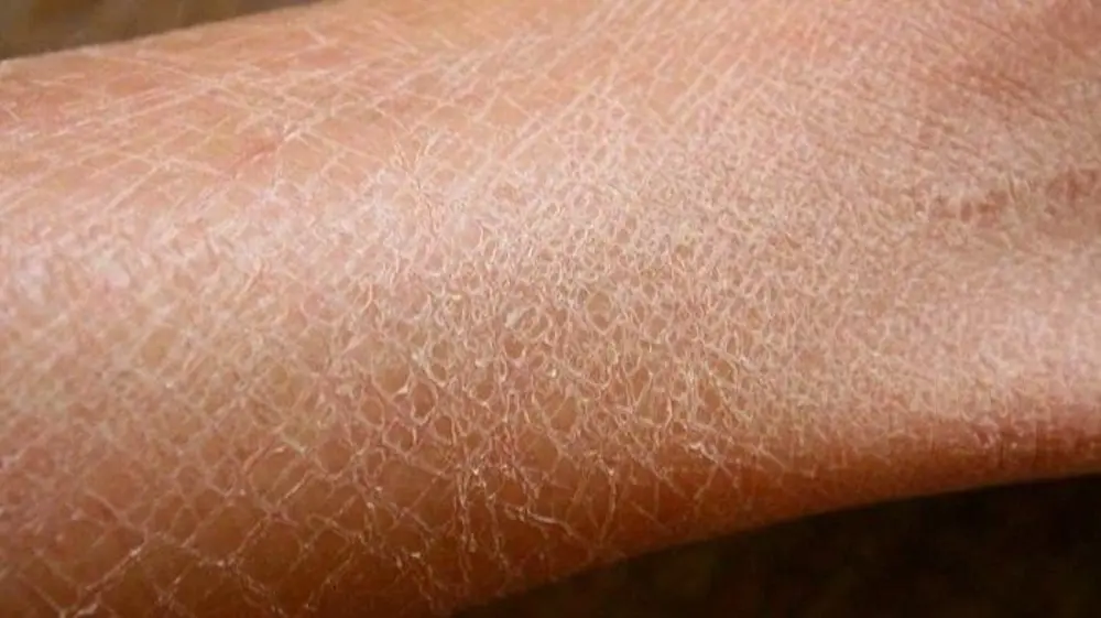 Cara Mengatasi Kulit Kering Bersisik dan Gatal